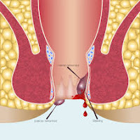 piles disease in hindi