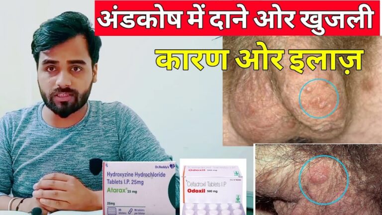 अंडकोष पर फोड़े फुंसी,सफेद दाने,खुजली का इलाज || Testicle Boils,Itching Treatment