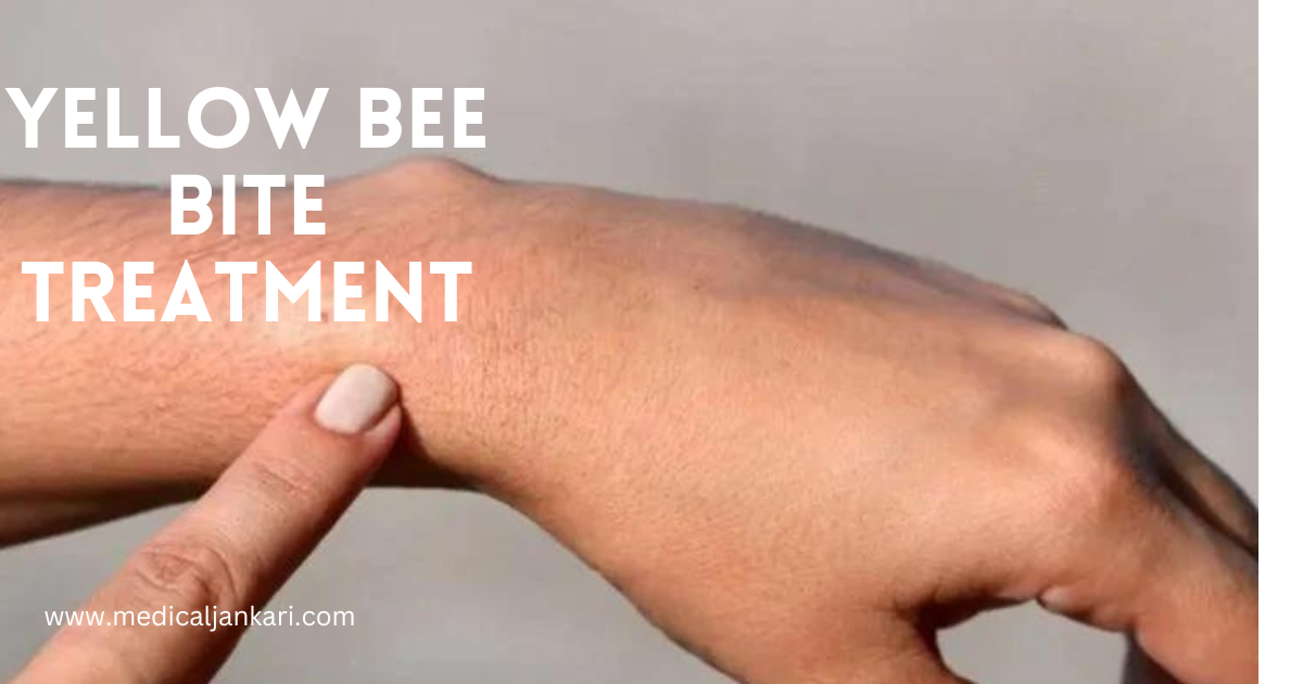 yellow bee bite treatment